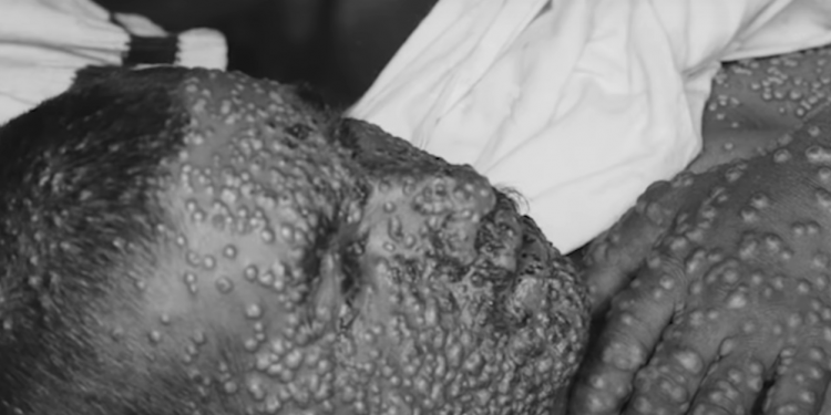 Każda epidemia w ZSRR zwalczana była przy użyciu wszystkich dostępnych sposobów, jeżeli zachodziła taka potrzeba nie przebierano w środkach.