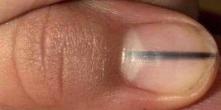 Makijażystka zauważyła to na paznokciu klientki. Uratowała jej życie