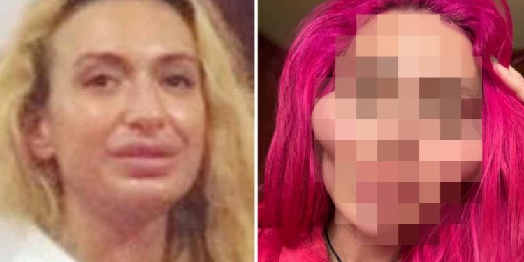 Operacje plastyczne zrobiły z niej potwora! Jej twarz już nie przypomina ludzkiej