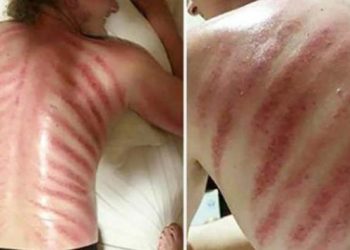 Obudził się z krwawymi pręgami. Okazało się, że to „pamiątka” poprzedniego wieczoru. Był w szoku