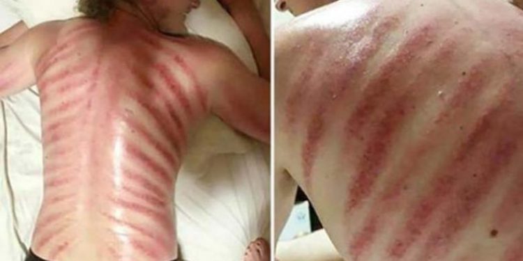 Obudził się z krwawymi pręgami. Okazało się, że to „pamiątka” poprzedniego wieczoru. Był w szoku